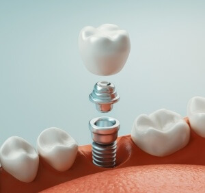 dental implant