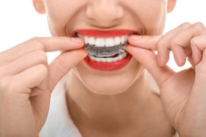 Invisalign clear aligners in Richmond correct many orthodontic issues discreetly and comfortably. Read more from Dr. William Way at Westhampton Dentistry.