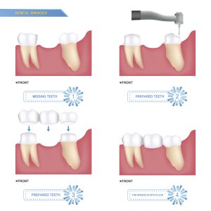 You want a great way to address your missing teeth – with dental bridges in 23226, you can make your smile healthy and happy again