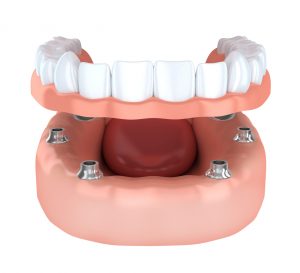 Dental implants in 23226 bond to the jaw