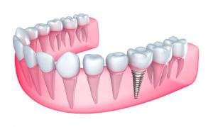 For dental implants in 23226, visit Dr. Way at Westhampton Dentistry. 