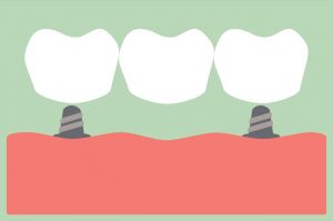 dental cartoon vector, dental bridge