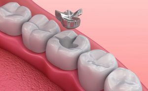 An illustration of dental fillings.