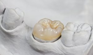 three tooth colored porcelain crowns