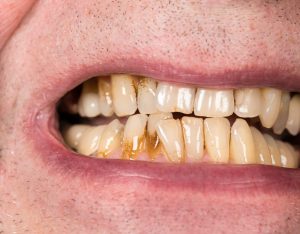 older man showing stained teeth